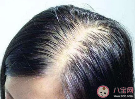 頭皮總是癢是什么原因怎么回事 緩解頭皮癢的小方法