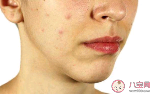 床上螨蟲咬了會(huì)有什么癥狀 被螨蟲咬了怎么辦 