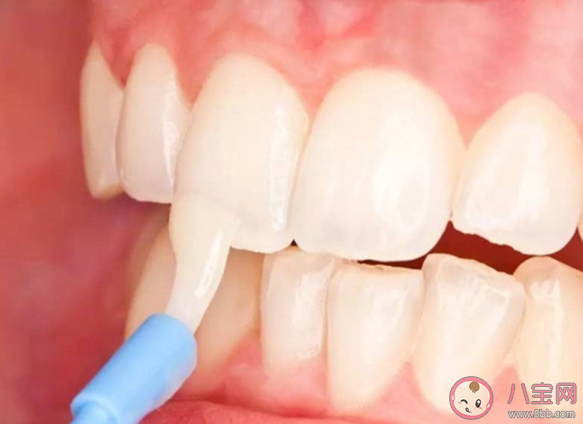 牙齒涂氟預防齲齒會有氟中毒風險嗎 生活中還有哪些氟的來源