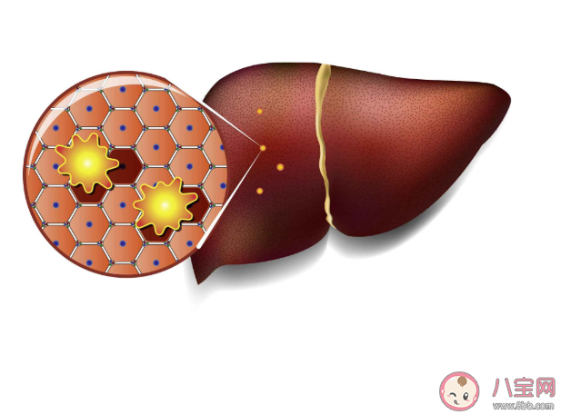 靠走路可以治愈脂肪肝嗎 日常如何預防與調理脂肪肝