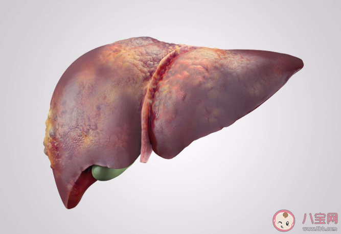 靠走路可以治愈脂肪肝嗎 日常如何預防與調理脂肪肝
