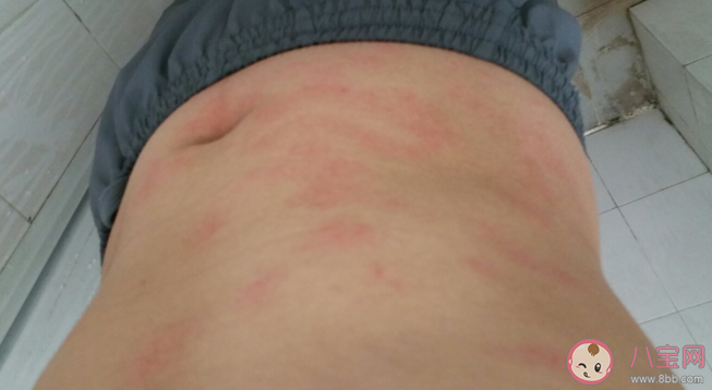 過敏性皮炎用什么藥好 過敏性皮炎患者如何做好生活管理 過敏性皮炎用什么藥好 過敏性皮炎患者如何做好生活管理