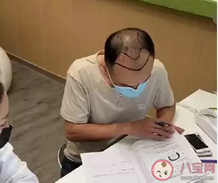 如何看待年輕人禿頭問題 哪些習(xí)慣會導(dǎo)致禿頭 如何看待年輕人禿頭問題 哪些習(xí)慣會導(dǎo)致禿頭