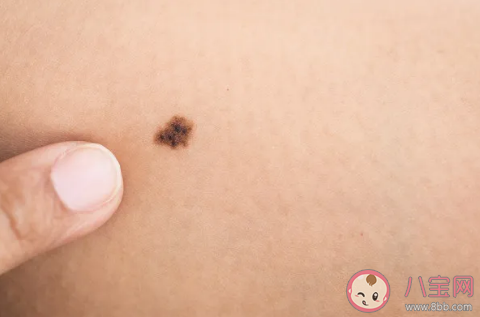 點完痣后當天可以敷面膜嗎 點痣后什么時候可以擦護膚品