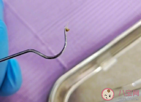 牙縫清潔到底有多重要 如何清潔牙縫