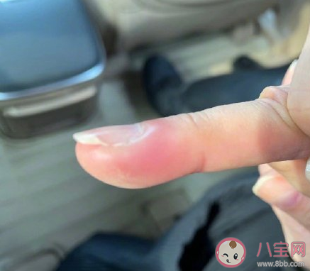 鄧萃雯拔倒刺發(fā)炎入院手術(shù)是怎么回事 拔倒刺會(huì)引起發(fā)炎嗎 鄧萃雯拔倒刺發(fā)炎入院手術(shù)是怎么回事 拔倒刺會(huì)引起發(fā)炎嗎