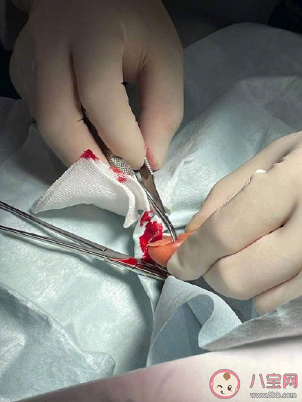 鄧萃雯拔倒刺發(fā)炎入院手術(shù)是怎么回事 拔倒刺會(huì)引起發(fā)炎嗎 鄧萃雯拔倒刺發(fā)炎入院手術(shù)是怎么回事 拔倒刺會(huì)引起發(fā)炎嗎