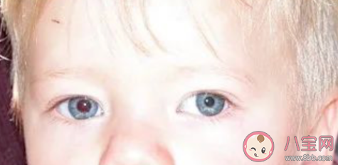 孩子弱視怎么及時(shí)發(fā)現(xiàn) 弱視如何治療 孩子弱視怎么及時(shí)發(fā)現(xiàn) 弱視如何治療