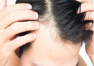 男青年最熱衷的醫美項目是植發嗎 植發后有哪些注意事項