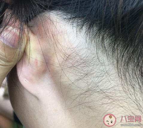 耳朵后面長了個包一按就疼怎么回事 耳朵后面長包怎么辦