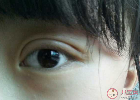 為什么下眼瞼里里面有一個小洞 眼睛下眼瞼有個小針眼是正常的嗎