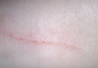 被寵物抓傷要打狂犬疫苗嗎 接種狂犬疫苗這些應(yīng)該知道