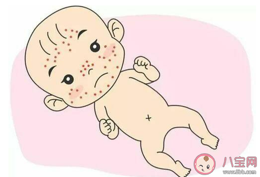 怎樣鑒別新生兒面皰和濕疹 面皰和濕疹具體區(qū)別是什么