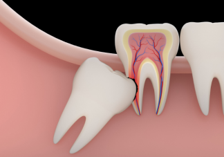 智齒每個人都會長嗎 智齒不痛要拔嗎