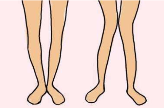 跑步走路外八該如何矯正 導致外八的原因有哪些