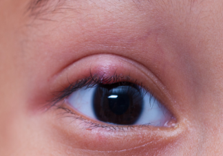 長了麥粒腫可以自己擠破嗎 長了麥粒腫怎么應對處理