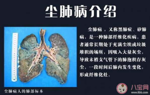 塵肺病到底有多嚴重 塵肺病如何預防