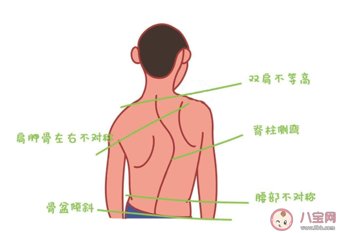 脊柱側彎可以完全復原嗎 脊柱側彎手術創傷大嗎