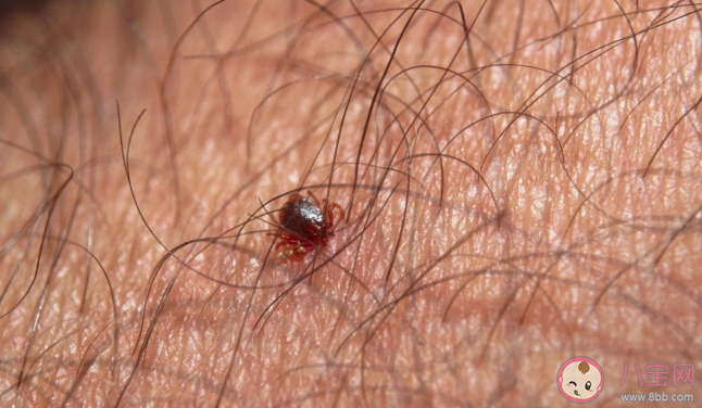 被蜱蟲叮咬就有致命危險嗎 被蜱蟲咬傷后有什么癥狀表現