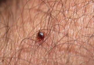 被蜱蟲叮咬就有致命危險嗎 被蜱蟲咬傷后有什么癥狀表現