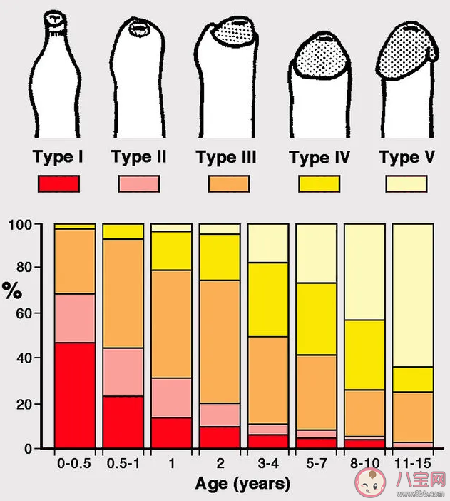 男孩包皮多長算正常 如何定義包皮過長