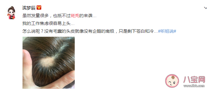 沈夢辰自爆斑禿是怎么回事 斑禿會自己好嗎