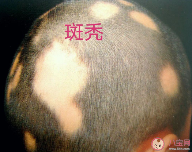 沈夢辰自爆斑禿是怎么回事 斑禿會自己好嗎