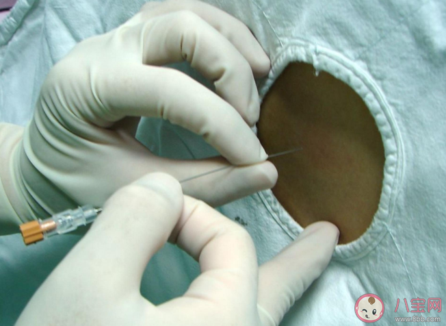 抗麻體質(zhì)是什么意思 剖腹產(chǎn)是半麻還是全麻