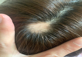 沈夢辰自爆斑禿是怎么回事 斑禿會自己好嗎