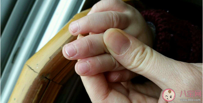 為什么總是忍不住拔倒刺 如何處理倒刺最靠譜