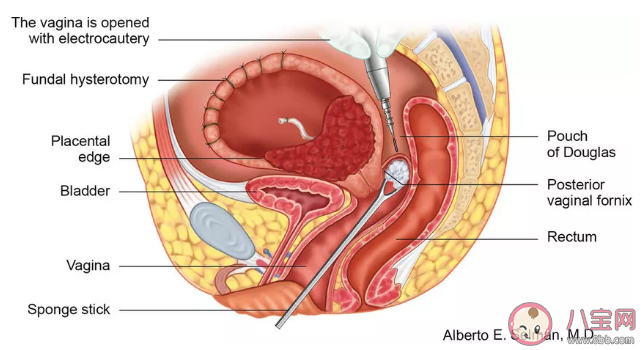 衛(wèi)生棉條塞到什么位置才算放對 衛(wèi)生棉條使用圖解 衛(wèi)生棉條塞到什么位置才算放對 衛(wèi)生棉條使用圖解