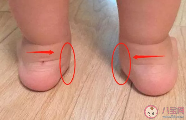 寶寶足外翻是什么樣子的 孩子足外翻怎么治療
