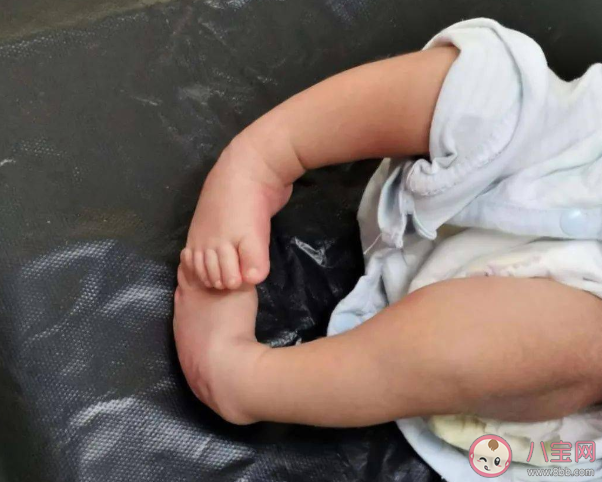 寶寶足外翻是什么樣子的 孩子足外翻怎么治療