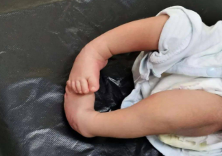 寶寶足外翻是什么樣子的 孩子足外翻怎么治療