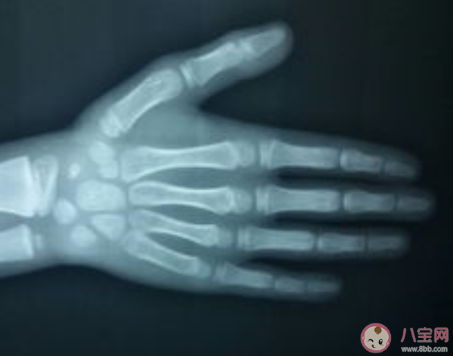 骨齡檢測最佳時間是什么時候 哪類人群需要檢測骨齡