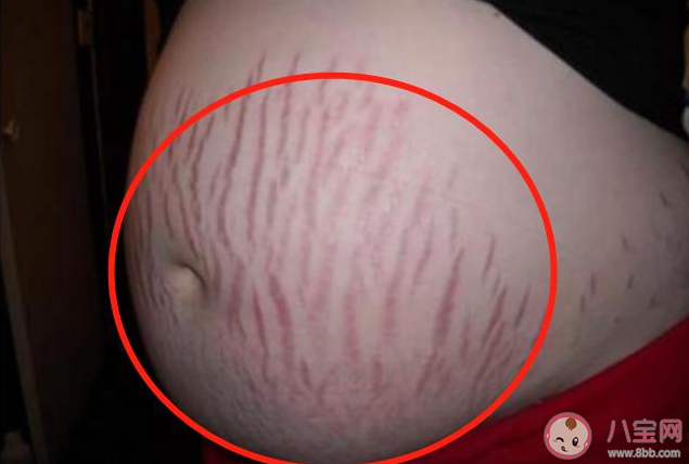 橄欖油能減淡已形成的妊娠紋嗎 出現妊娠紋還能補救嗎