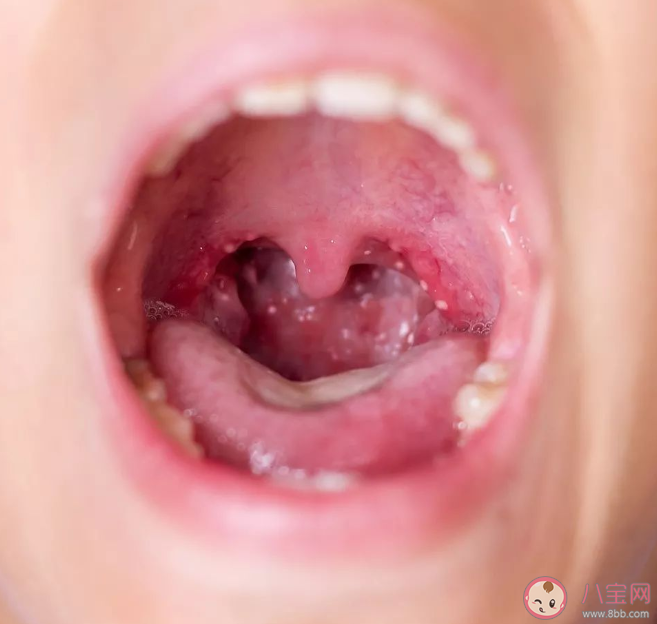 感染皰疹性咽峽炎怎么讓孩子好得快 日常如何做好預(yù)防措施