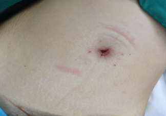 瘢痕子宮如何備孕二胎 如何避免發生瘢痕子宮