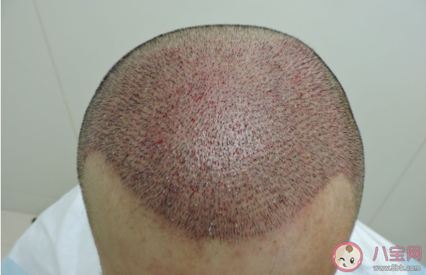 植發手術疼嗎 植發手術第幾天可以洗頭