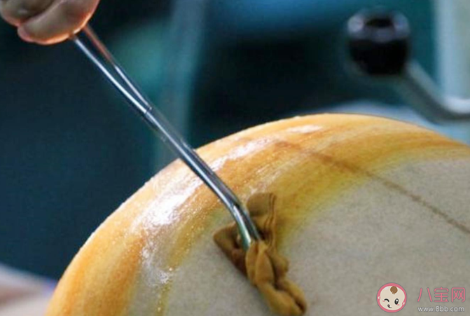 剖腹產橫切豎切怎么選 豎切和橫切哪個會更疼