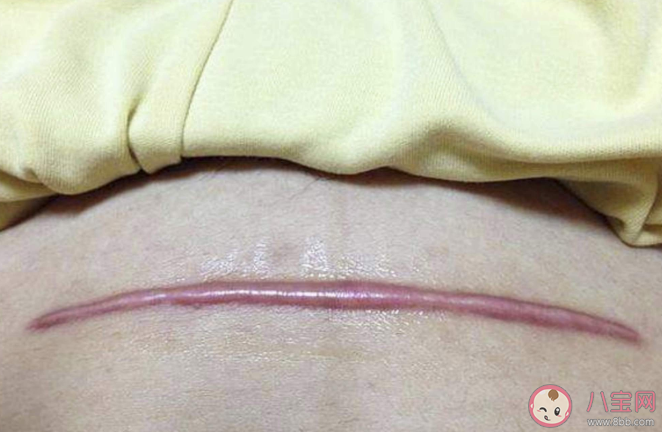 剖腹產橫切豎切怎么選 豎切和橫切哪個會更疼