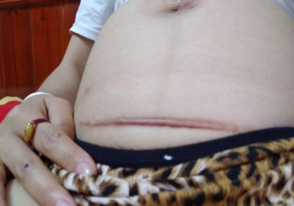剖腹產(chǎn)橫切豎切怎么選 豎切和橫切哪個(gè)會(huì)更疼