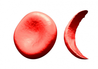 男人出現貧血有什么癥狀表現 男人貧血是什么原因