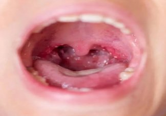 孩子皰疹性咽峽炎不愿意吃東西怎么辦 得了皰疹性咽峽炎要隔離嗎