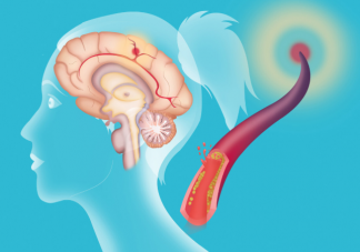 經(jīng)常吃哪些食物能預(yù)防中風(fēng)保護(hù)血管 哪些食物要少吃