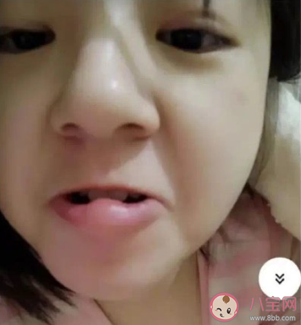 被蚊子叮過最尷尬的位置是哪 被蚊子咬了怎么止癢