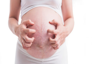 懷孕妊娠紋很癢怎么緩解 孕期妊娠紋為什么會癢