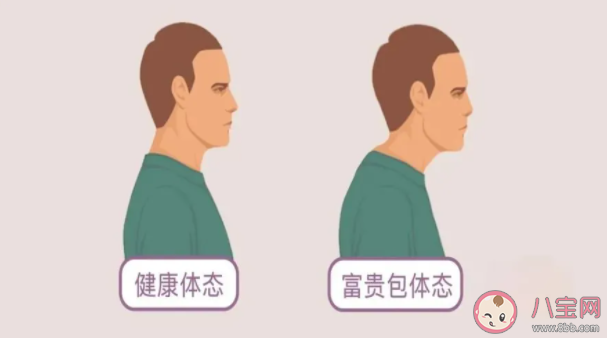 頸部長富貴包怎么改善 做什么動作能改善富貴包