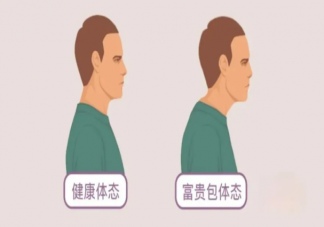頸部長富貴包怎么改善 做什么動作能改善富貴包