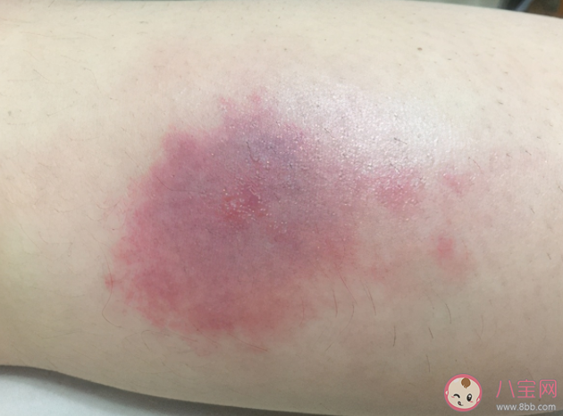 蚊子叮在身體的哪個(gè)部位最癢 如何快速止癢消腫不留疤